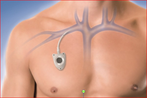 Chambre Implantable